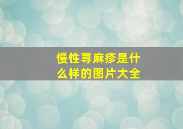 慢性荨麻疹是什么样的图片大全