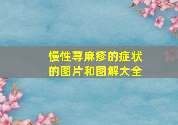 慢性荨麻疹的症状的图片和图解大全