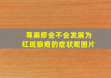 荨麻疹会不会发展为红斑狼疮的症状呢图片