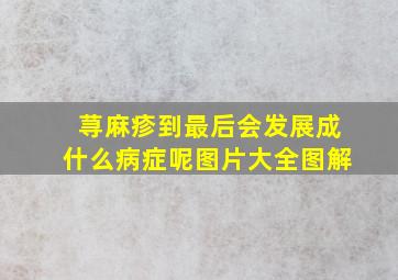 荨麻疹到最后会发展成什么病症呢图片大全图解