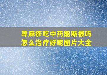 荨麻疹吃中药能断根吗怎么治疗好呢图片大全